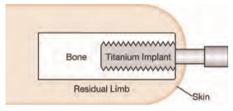 prosthetic osseointegration implant suspension